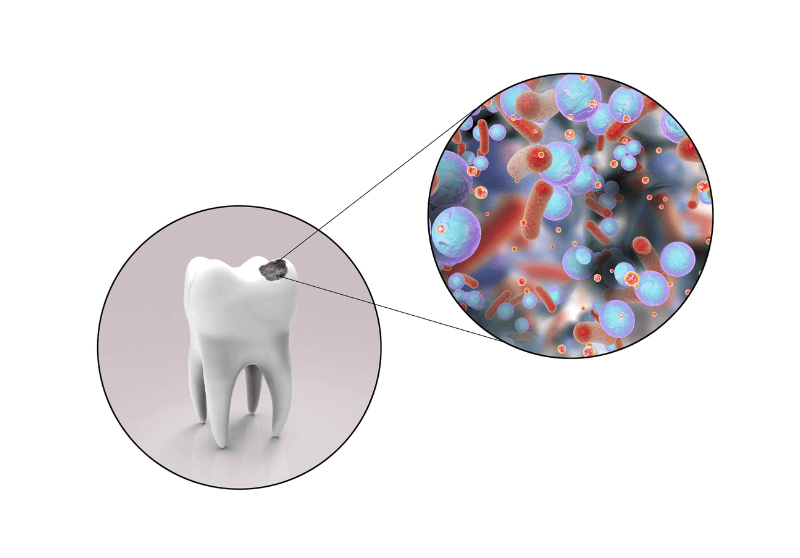 Tooth in a microscope on how tooth decay works in a tooth, Dental Insurance Plans can help the problem